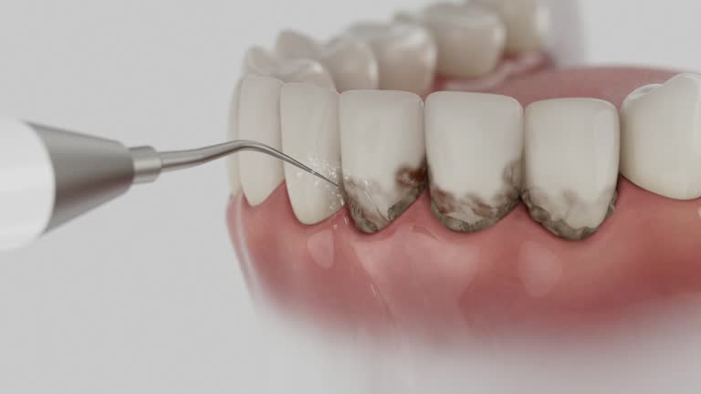 Trusted Dental Crowns And Bridges service in Ellicott, CO - Dentist Open Now